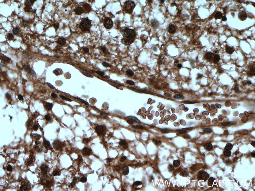 Immunohistochemistry (IHC) staining of human gliomas tissue using DCUN1D1 Polyclonal antibody (10965-1-AP)