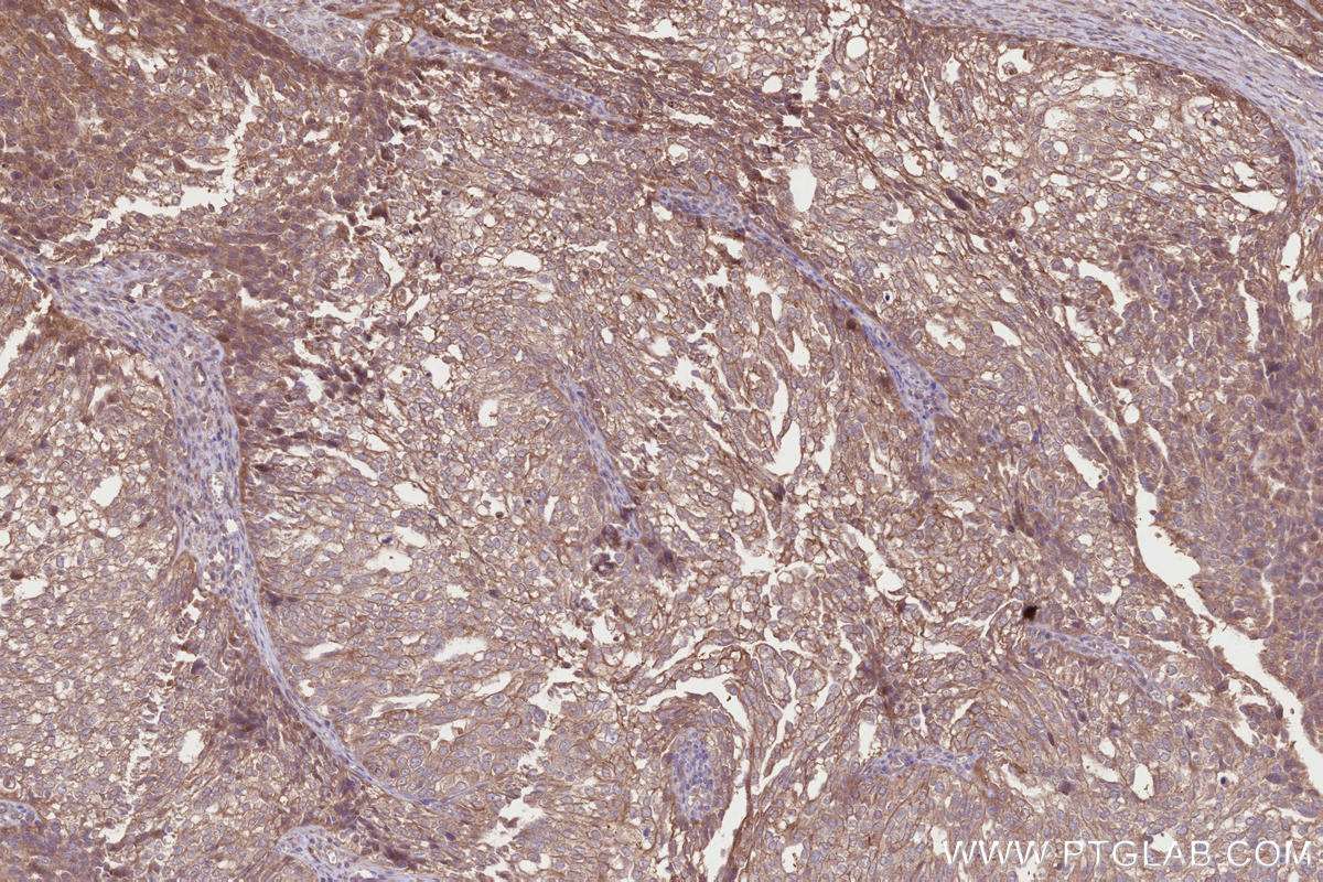 Immunohistochemistry (IHC) staining of human ovary cancer tissue using DCUN1D3 Polyclonal antibody (26356-1-AP)
