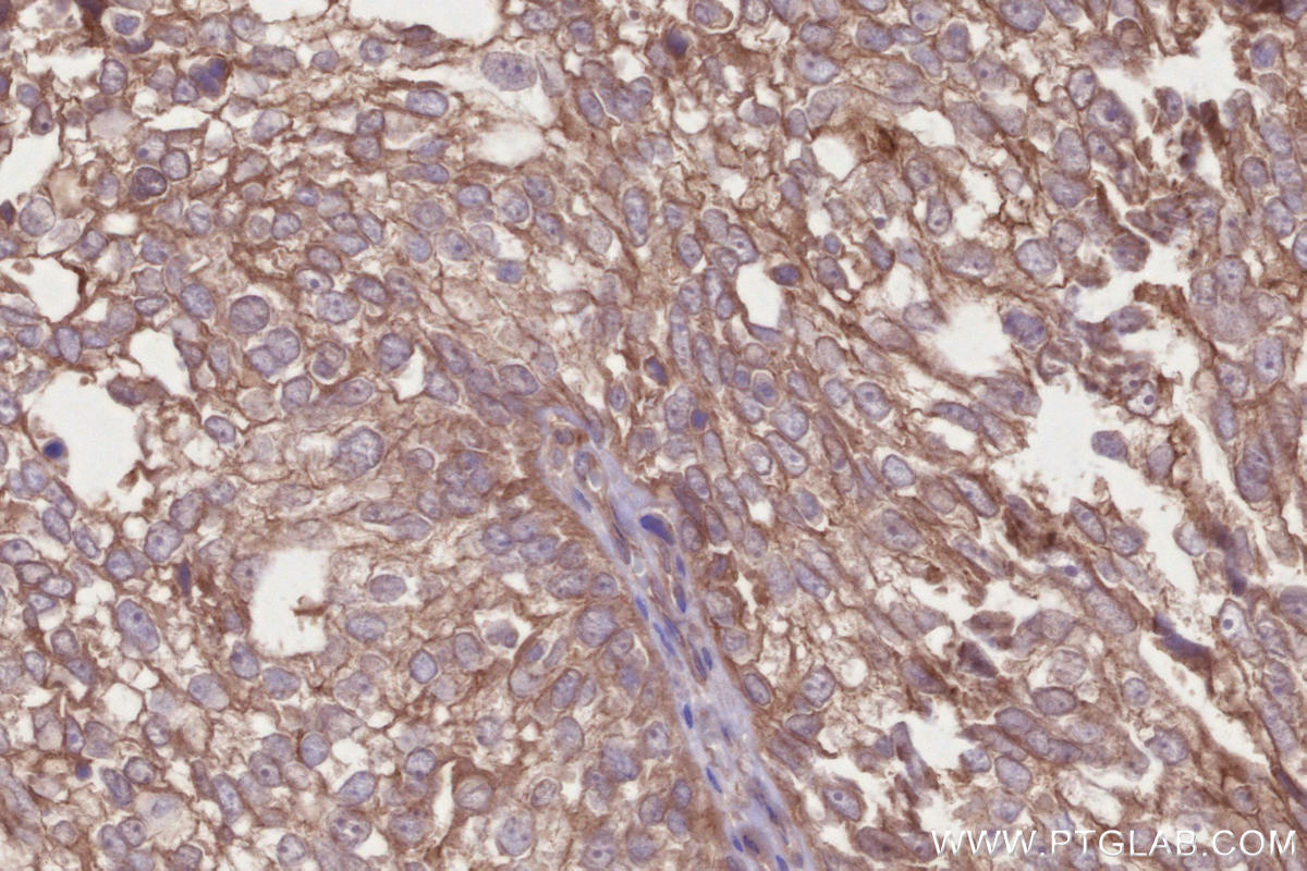 Immunohistochemistry (IHC) staining of human ovary cancer tissue using DCUN1D3 Polyclonal antibody (26356-1-AP)