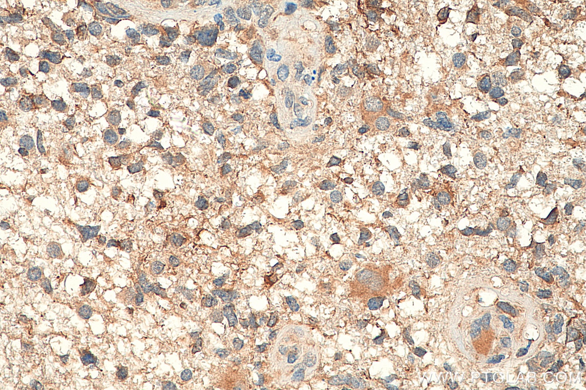 Immunohistochemistry (IHC) staining of human gliomas tissue using DCX Polyclonal antibody (13925-1-AP)
