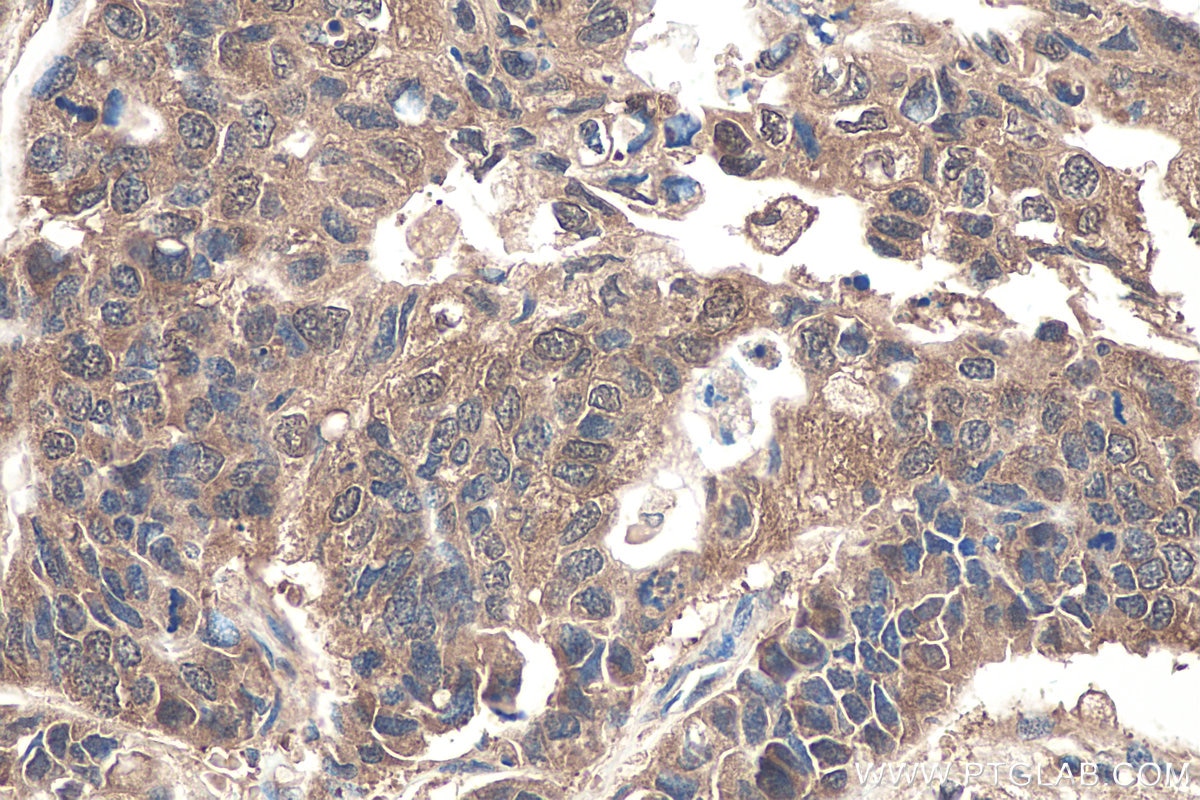 Immunohistochemistry (IHC) staining of human stomach cancer tissue using DDAH1 Polyclonal antibody (30108-1-AP)