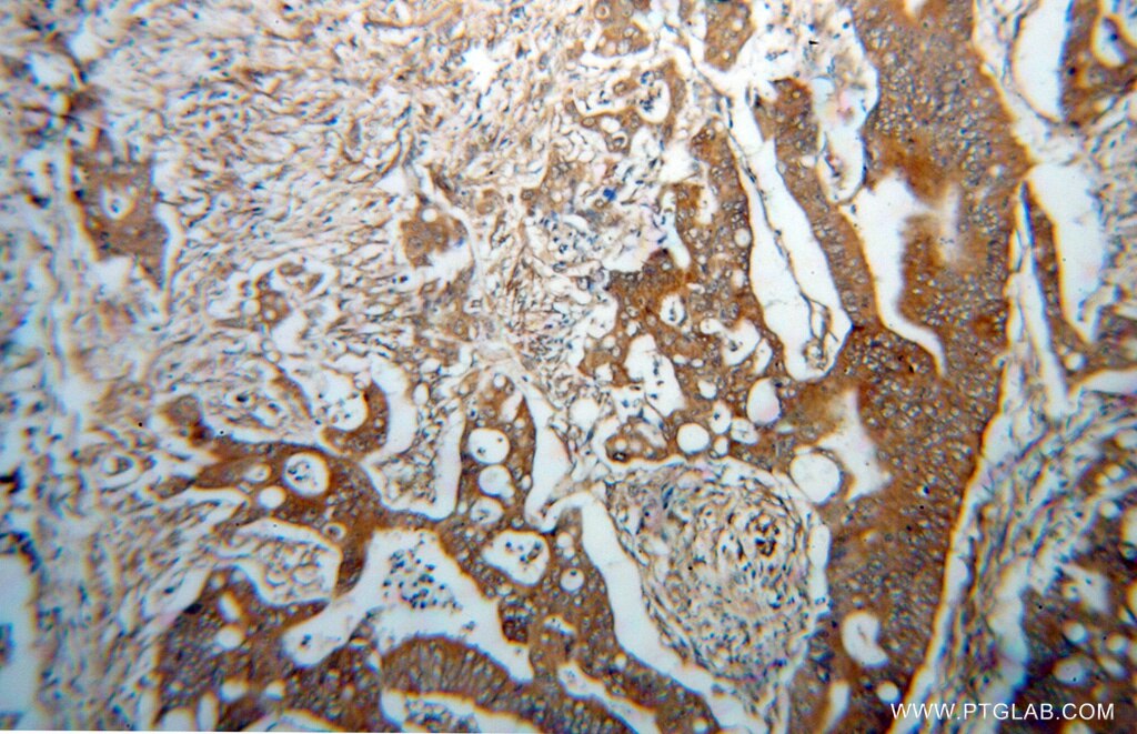 Immunohistochemistry (IHC) staining of human colon cancer tissue using DDAH2 Polyclonal antibody (14966-1-AP)