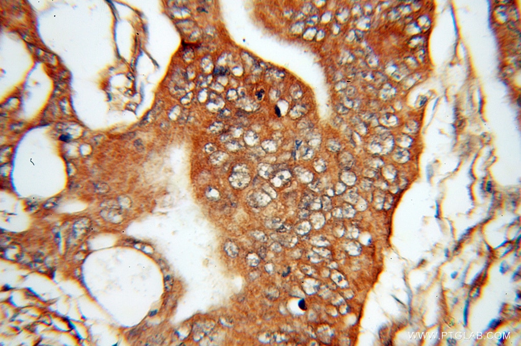 Immunohistochemistry (IHC) staining of human colon cancer tissue using DDAH2 Polyclonal antibody (14966-1-AP)