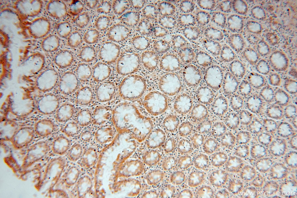 Immunohistochemistry (IHC) staining of human colon cancer tissue using DDAH2 Polyclonal antibody (14966-1-AP)