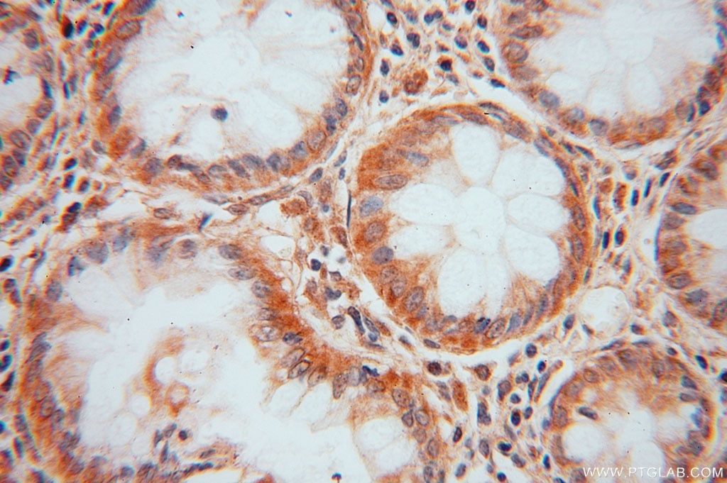 Immunohistochemistry (IHC) staining of human colon cancer tissue using DDAH2 Polyclonal antibody (14966-1-AP)