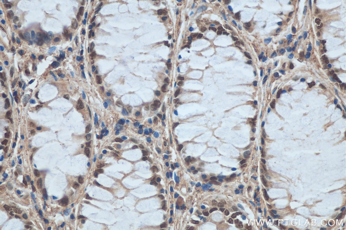Immunohistochemistry (IHC) staining of human colon cancer tissue using DDB1 Polyclonal antibody (11380-1-AP)
