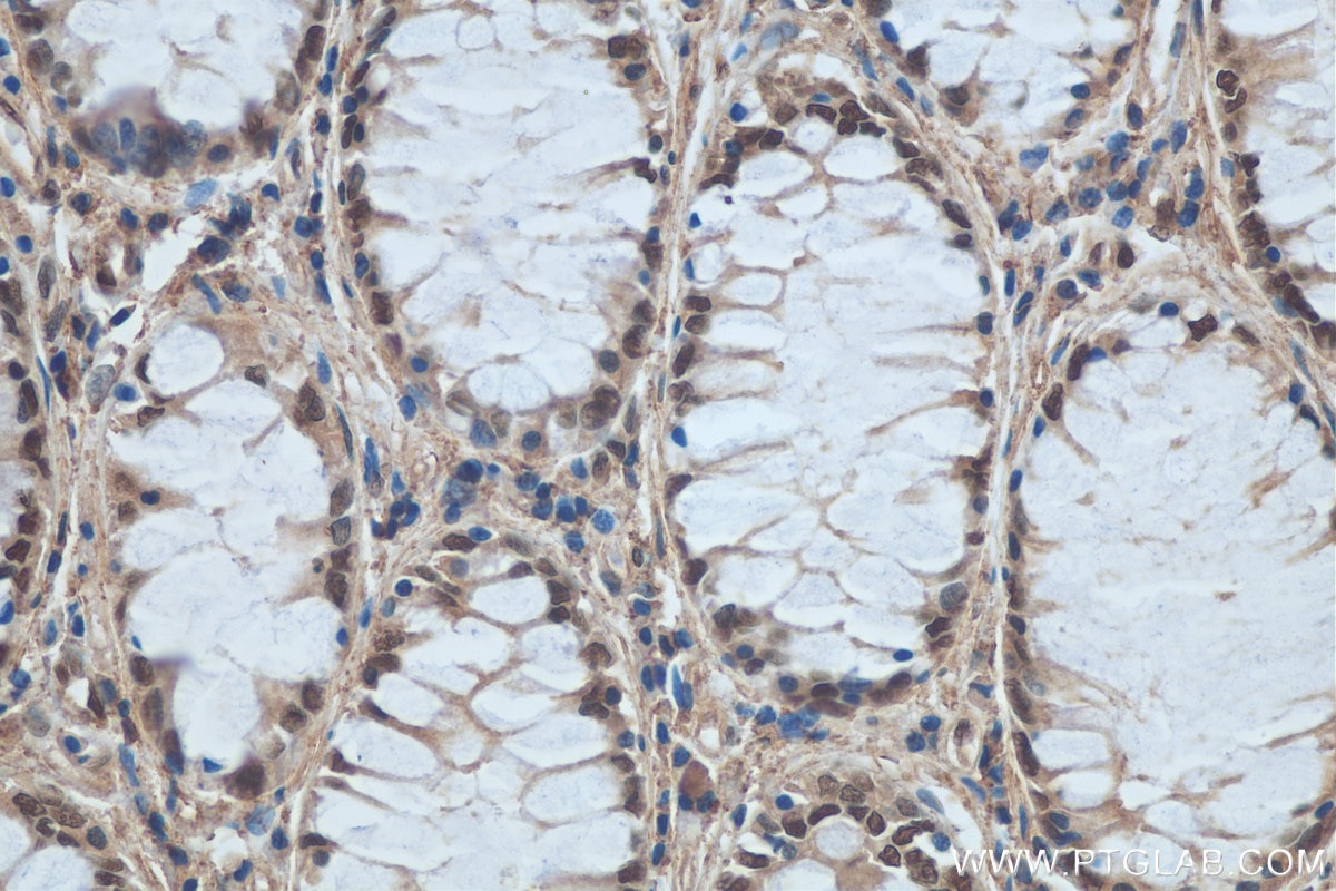 IHC staining of human colon cancer using 11380-1-AP