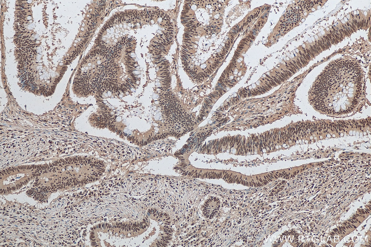 Immunohistochemistry (IHC) staining of human colon cancer tissue using DDB1 Polyclonal antibody (11380-1-AP)