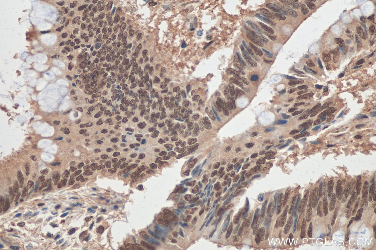 Immunohistochemistry (IHC) staining of human colon cancer tissue using DDB1 Polyclonal antibody (11380-1-AP)