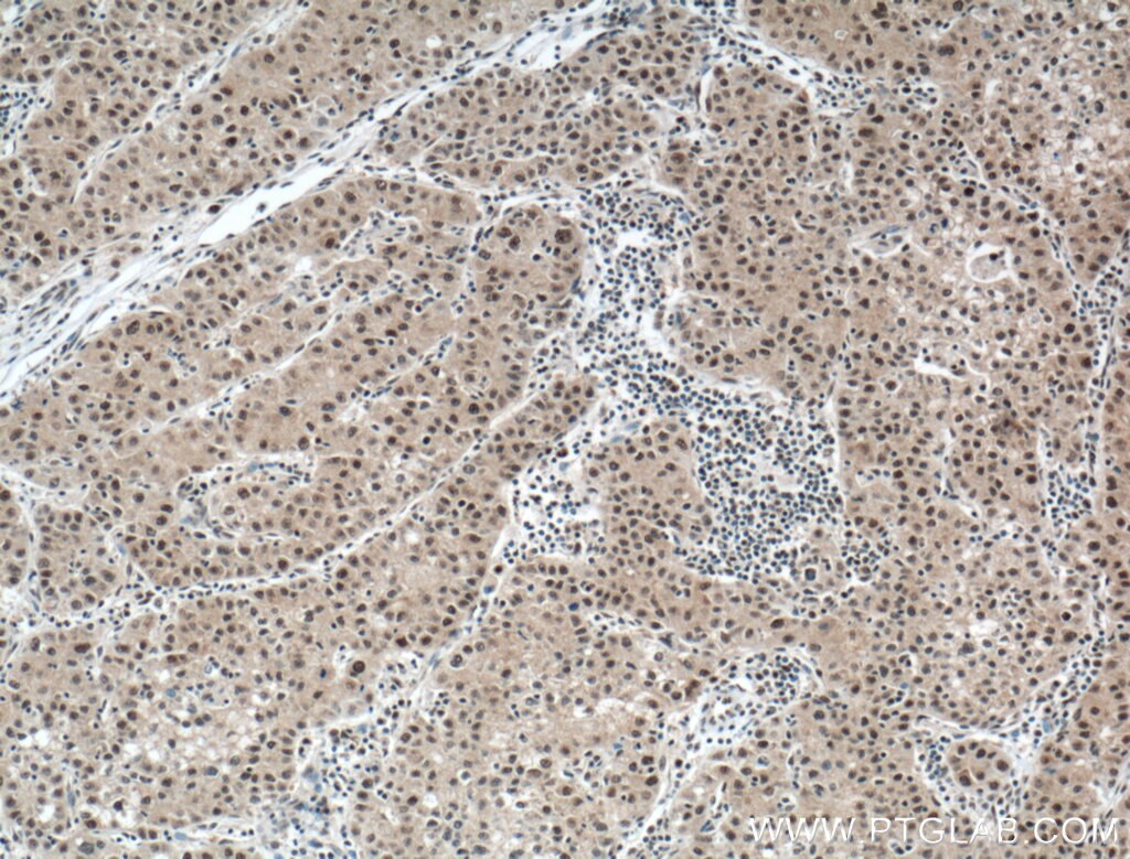 Immunohistochemistry (IHC) staining of human liver cancer tissue using DDB1 Monoclonal antibody (66010-1-Ig)