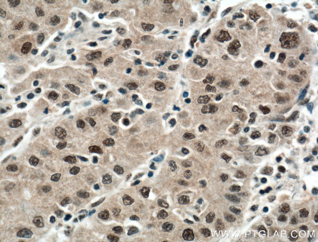 Immunohistochemistry (IHC) staining of human liver cancer tissue using DDB1 Monoclonal antibody (66010-1-Ig)