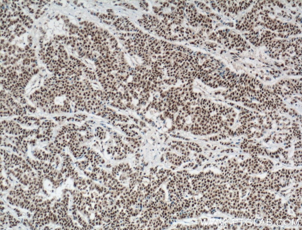 Immunohistochemistry (IHC) staining of human colon cancer tissue using DDB1 Monoclonal antibody (66010-1-Ig)