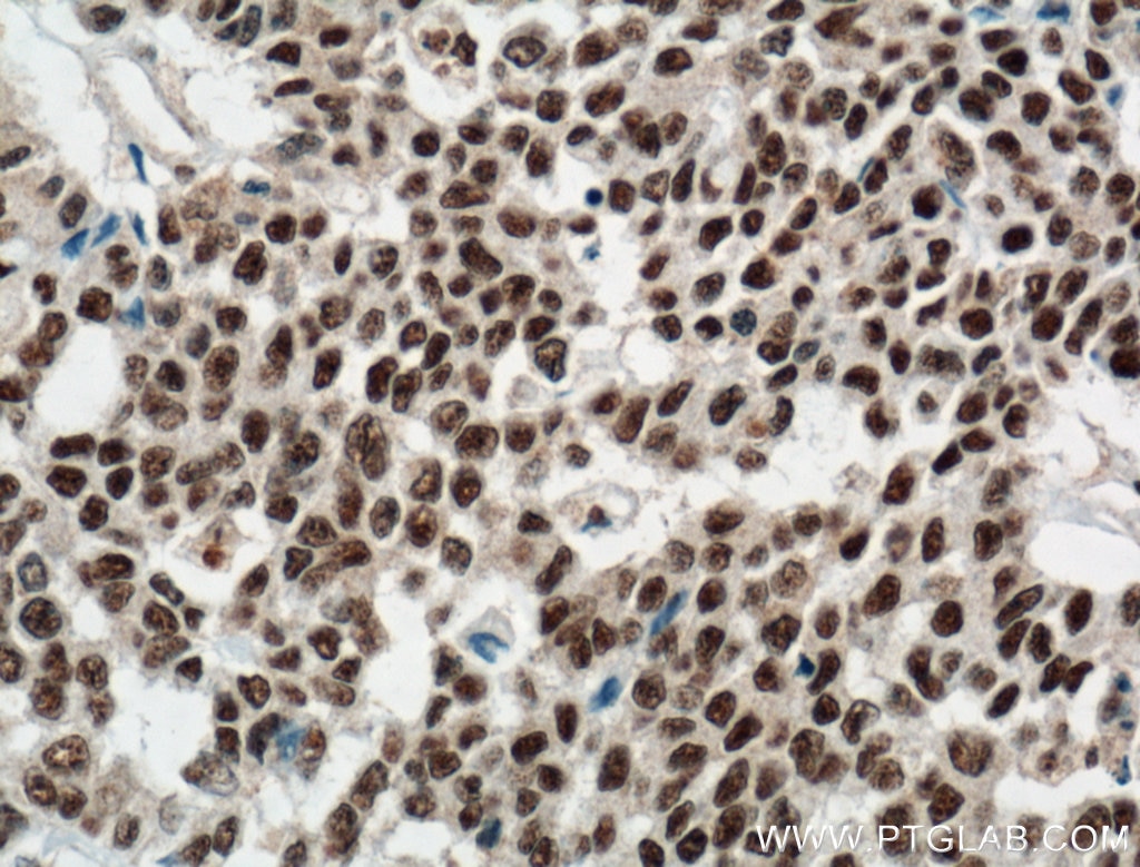 IHC staining of human colon cancer using 66010-1-Ig