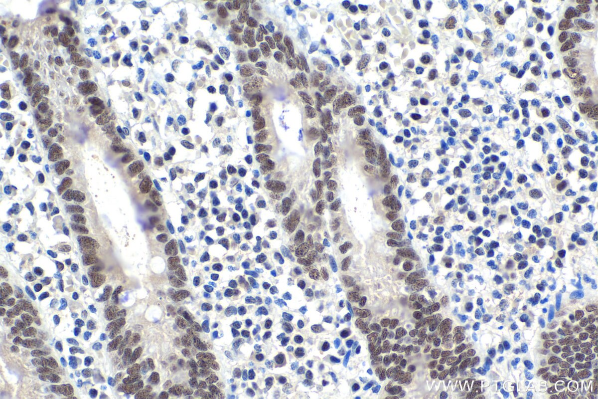 Immunohistochemistry (IHC) staining of human appendicitis tissue using DDB1 Monoclonal antibody (66010-1-Ig)