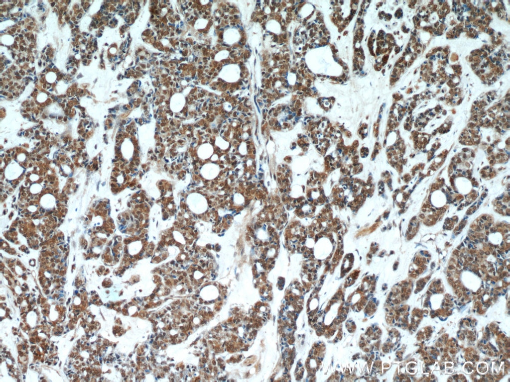 Immunohistochemistry (IHC) staining of human cervical cancer tissue using DDB1 Monoclonal antibody (66010-1-Ig)
