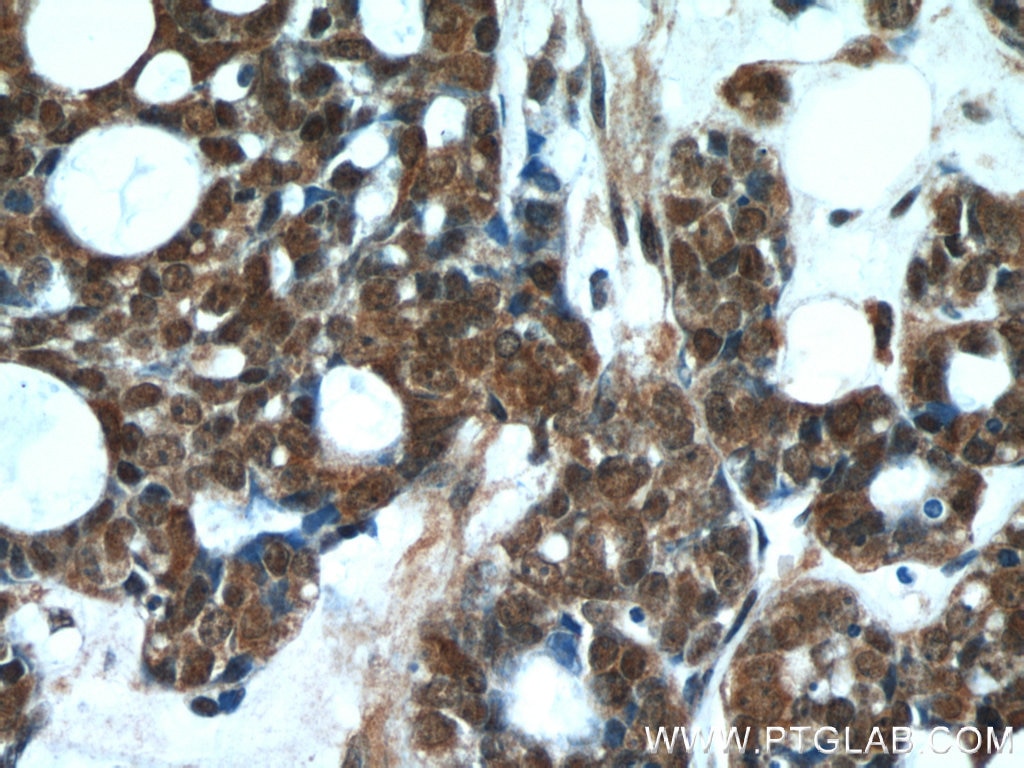 Immunohistochemistry (IHC) staining of human cervical cancer tissue using DDB1 Monoclonal antibody (66010-1-Ig)
