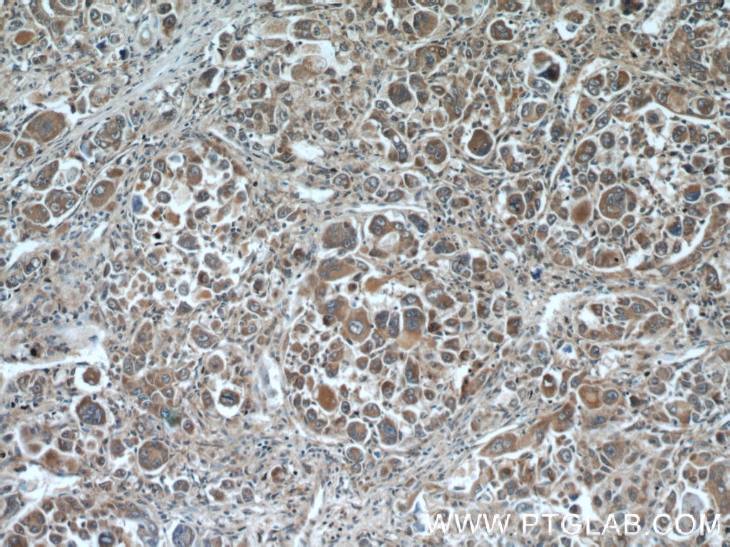 Immunohistochemistry (IHC) staining of human liver cancer tissue using DOPA decarboxylase Polyclonal antibody (10166-1-AP)