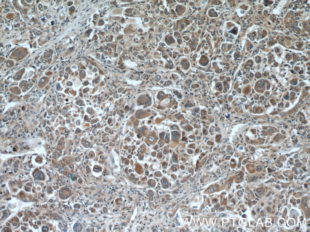 Immunohistochemistry (IHC) staining of human liver cancer tissue using DOPA decarboxylase/DDC Polyclonal antibody (10166-1-AP)