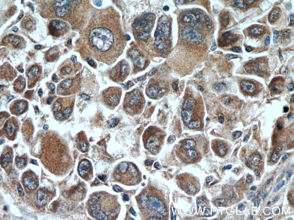 IHC staining of human liver cancer using 10166-1-AP
