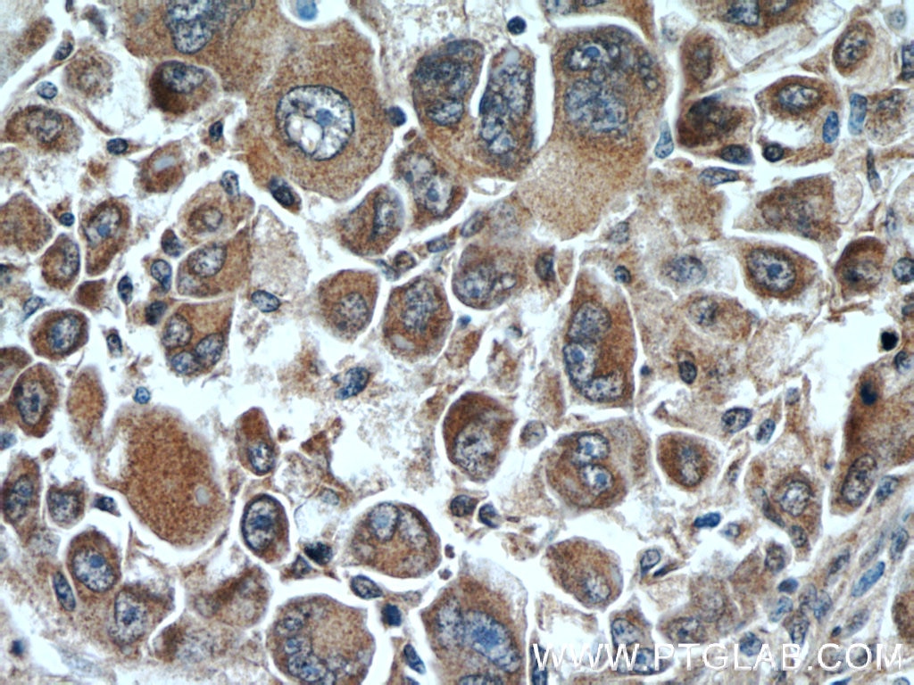 Immunohistochemistry (IHC) staining of human liver cancer tissue using DOPA decarboxylase Polyclonal antibody (10166-1-AP)