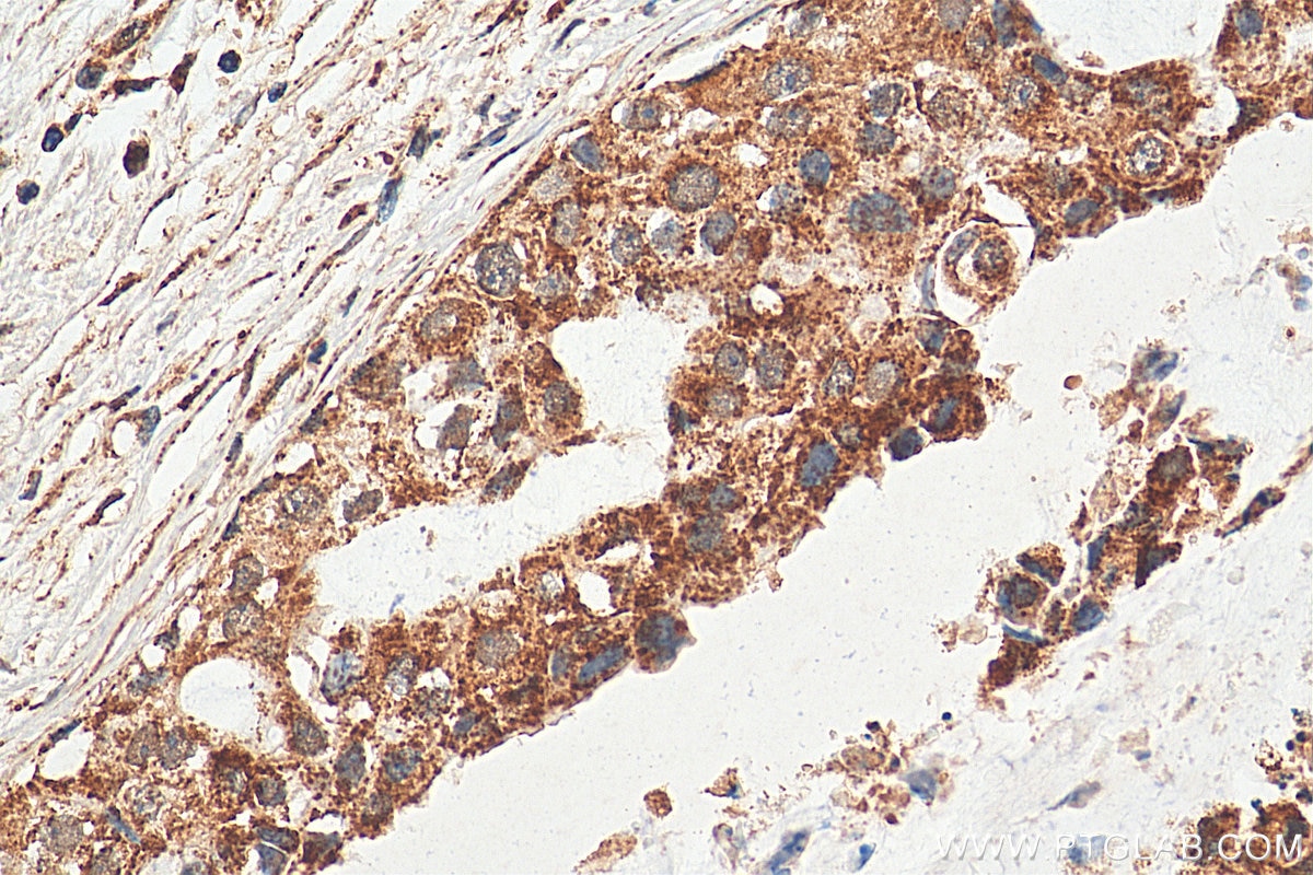 Immunohistochemistry (IHC) staining of human breast cancer tissue using CHOP; GADD153 Polyclonal antibody (15204-1-AP)