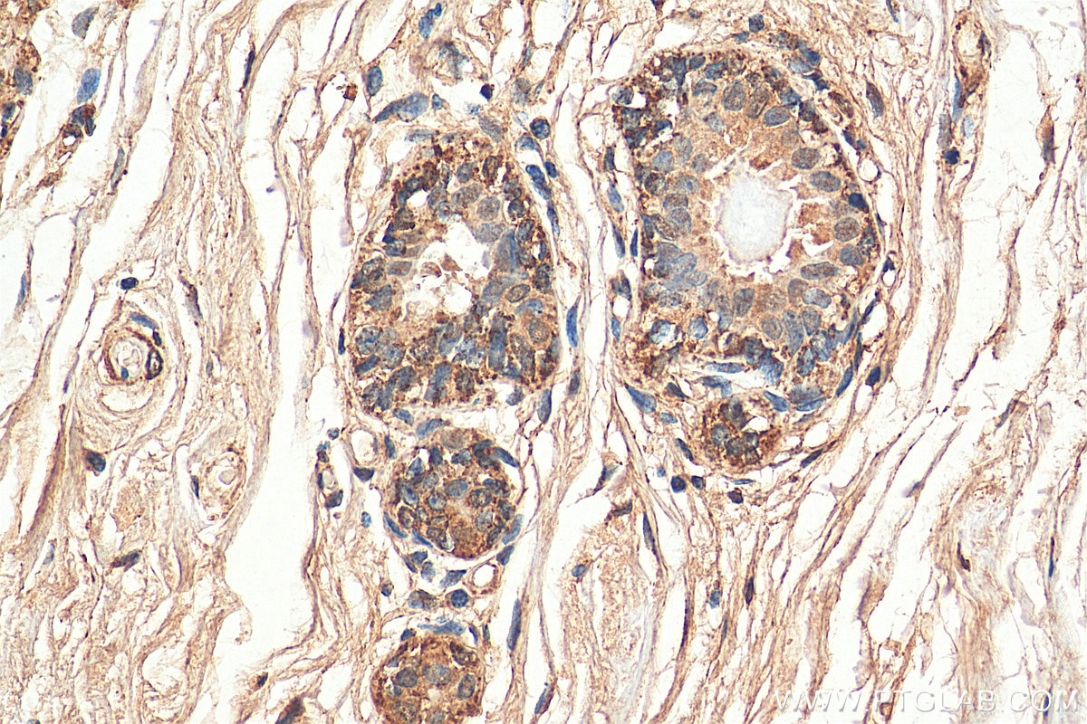 Immunohistochemistry (IHC) staining of human breast cancer tissue using CHOP; GADD153 Polyclonal antibody (15204-1-AP)