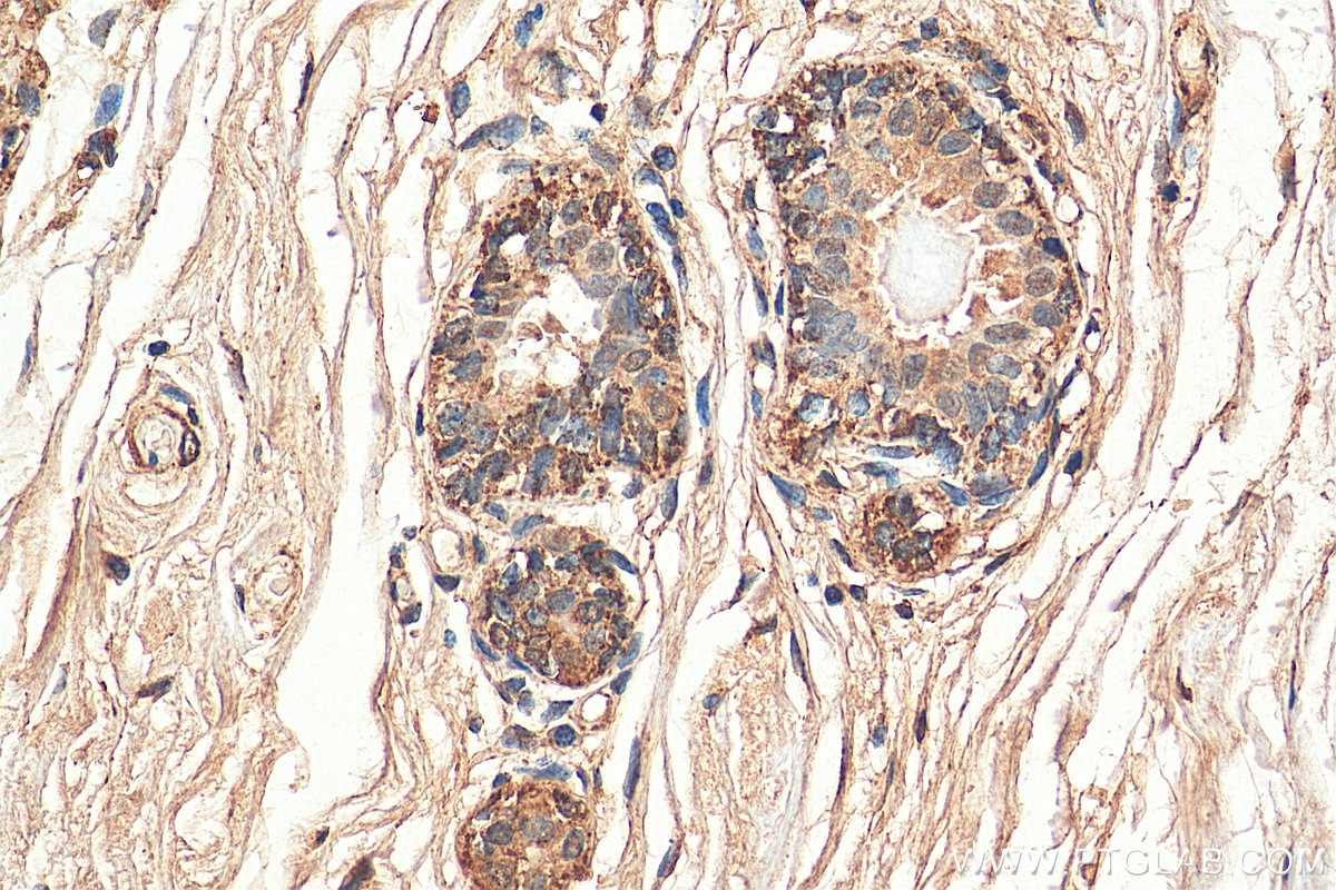 IHC staining of human breast cancer using 15204-1-AP