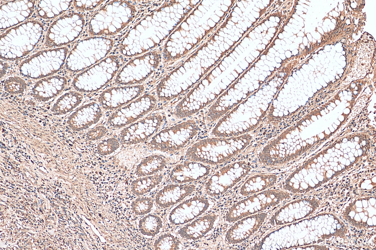 Immunohistochemistry (IHC) staining of human colon cancer tissue using CHOP; GADD153 Polyclonal antibody (15204-1-AP)