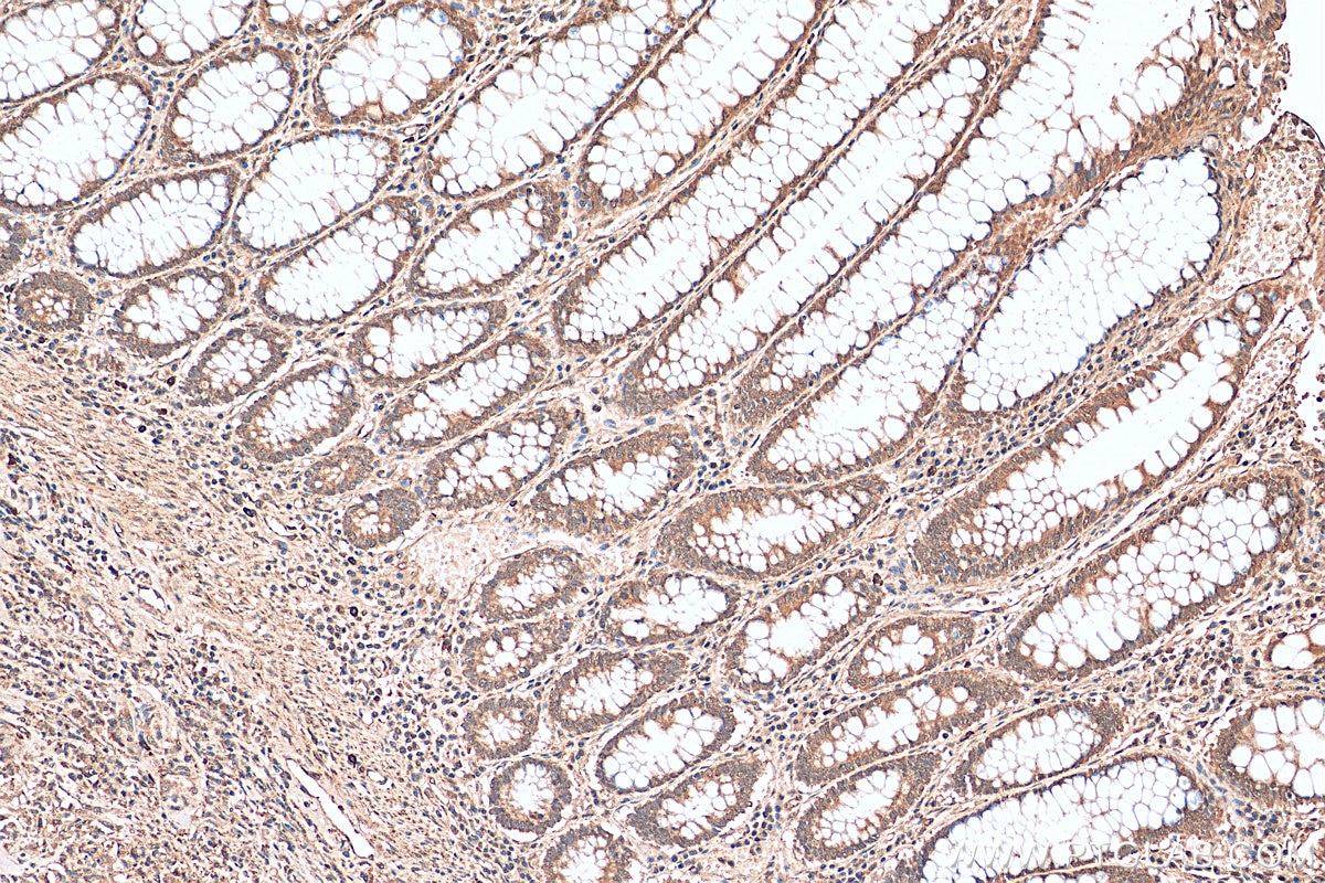 IHC staining of human colon cancer using 15204-1-AP