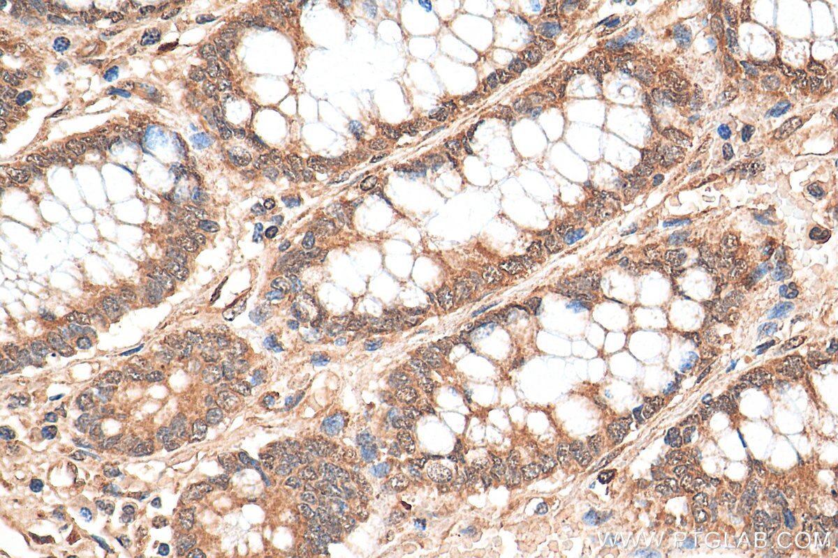 Immunohistochemistry (IHC) staining of human colon cancer tissue using CHOP; GADD153 Polyclonal antibody (15204-1-AP)