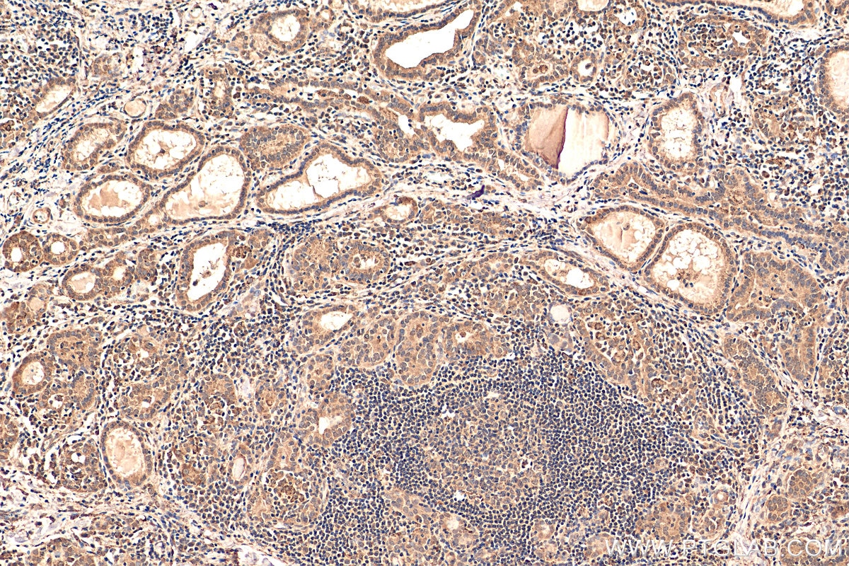 Immunohistochemistry (IHC) staining of human thyroid cancer tissue using CHOP; GADD153 Polyclonal antibody (15204-1-AP)