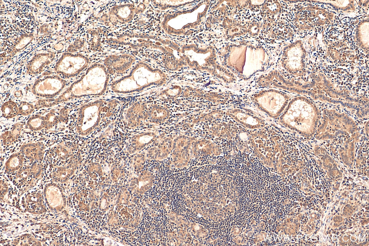 IHC staining of human thyroid cancer using 15204-1-AP