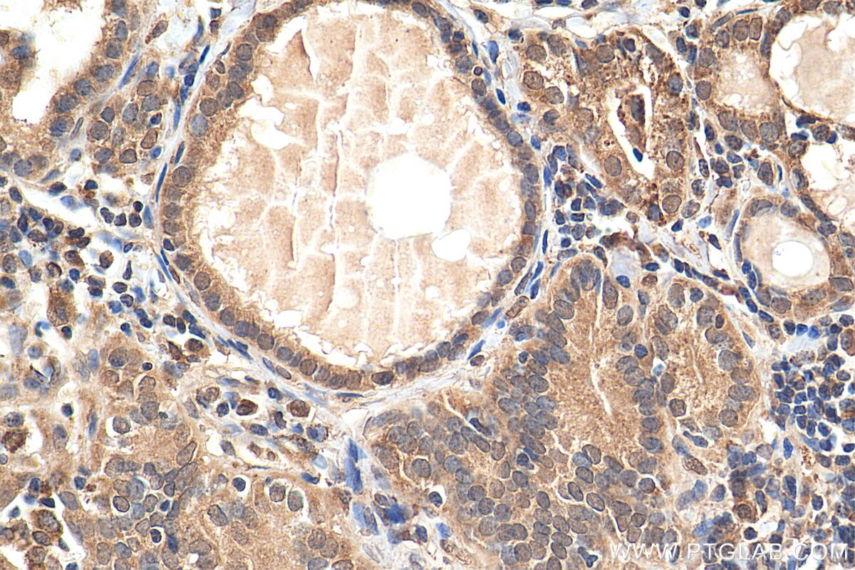 Immunohistochemistry (IHC) staining of human thyroid cancer tissue using CHOP; GADD153 Polyclonal antibody (15204-1-AP)