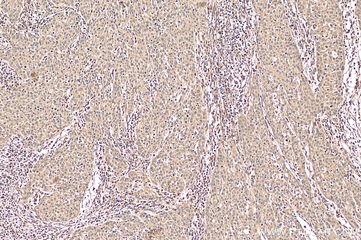Immunohistochemistry (IHC) staining of human cervical cancer tissue using CHOP; GADD153 Polyclonal antibody (15204-1-AP)