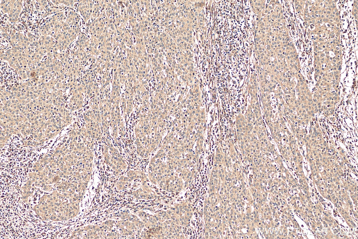 IHC staining of human cervical cancer using 15204-1-AP