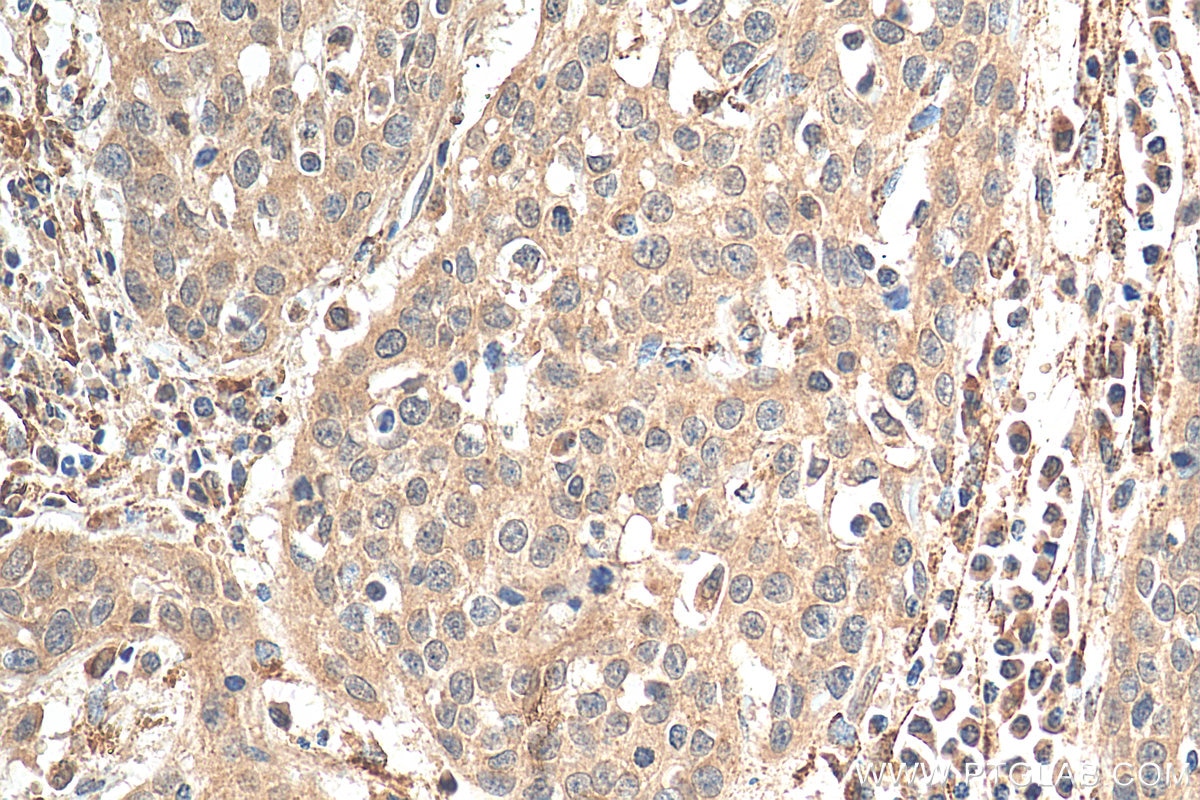 IHC staining of human cervical cancer using 15204-1-AP