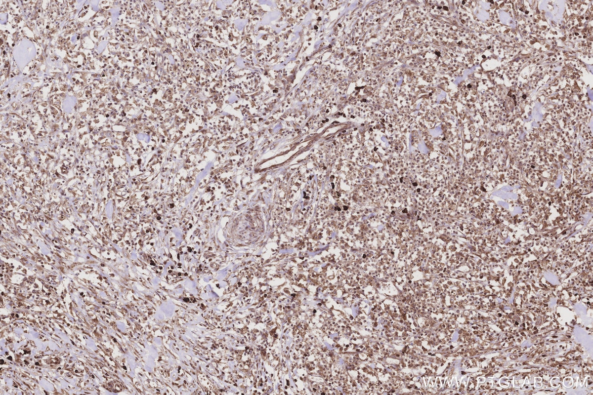 IHC staining of human colon cancer using 14916-1-AP Immunohistochemistry (IHC) staining of human colon cancer tissue using DDOST Polyclonal antibody (14916-1-AP)