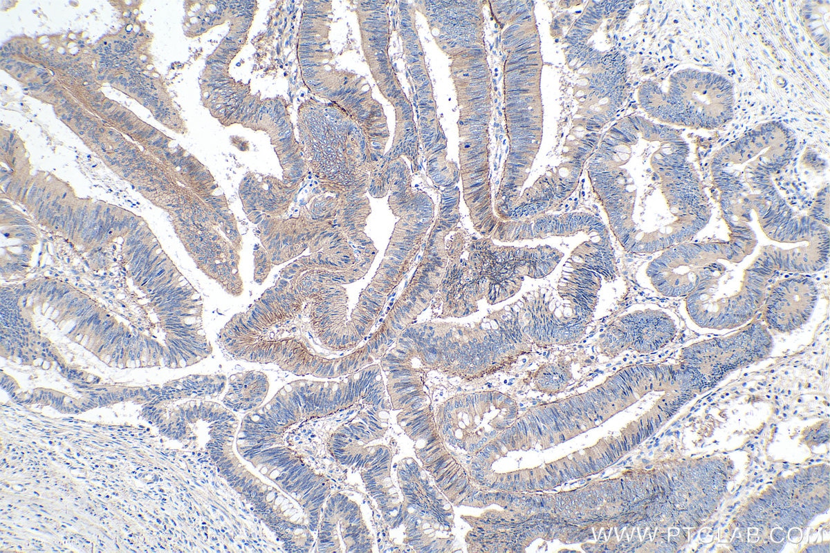 Immunohistochemistry (IHC) staining of human colon cancer tissue using DDR1 Polyclonal antibody (10536-1-AP)