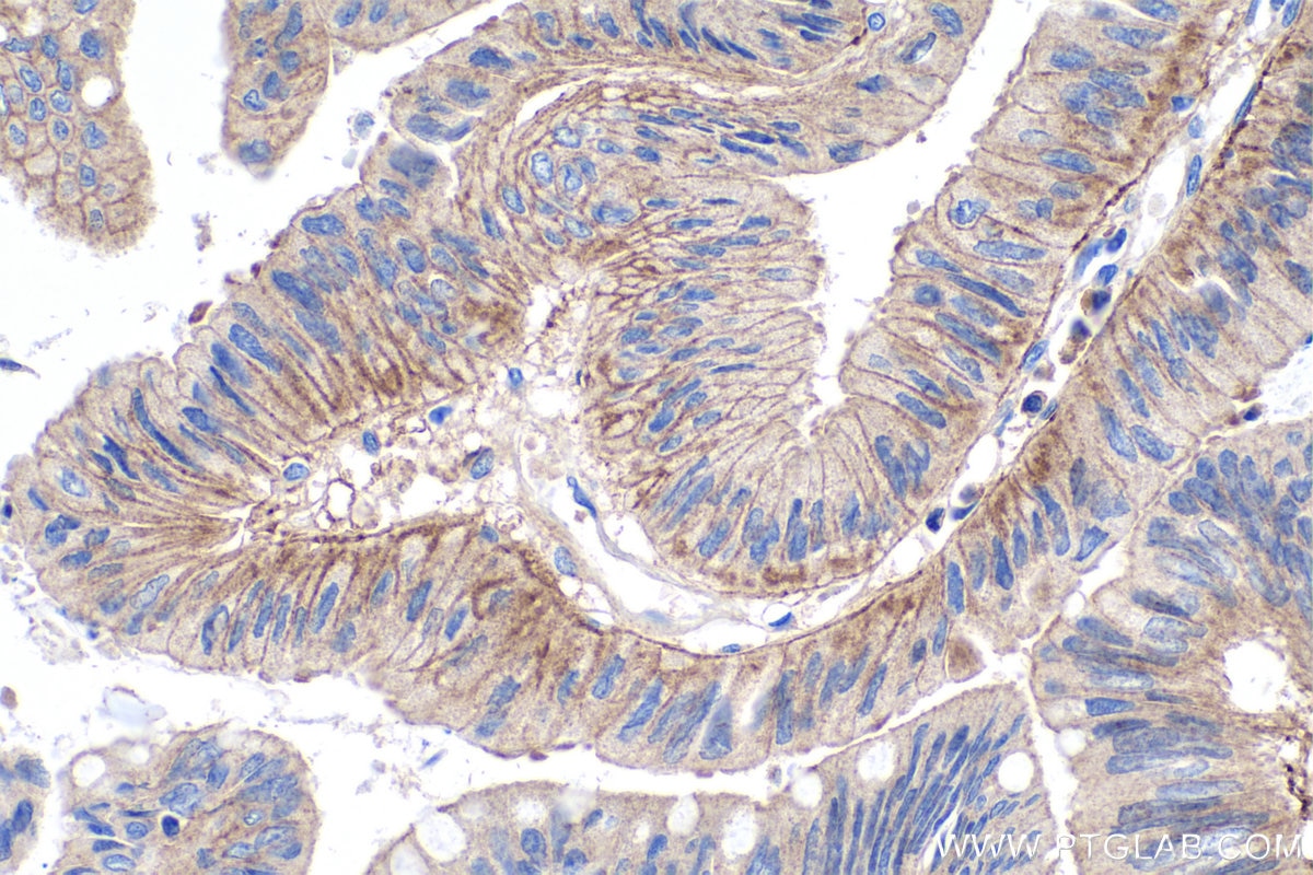 Immunohistochemistry (IHC) staining of human colon cancer tissue using DDR1 Polyclonal antibody (10536-1-AP)
