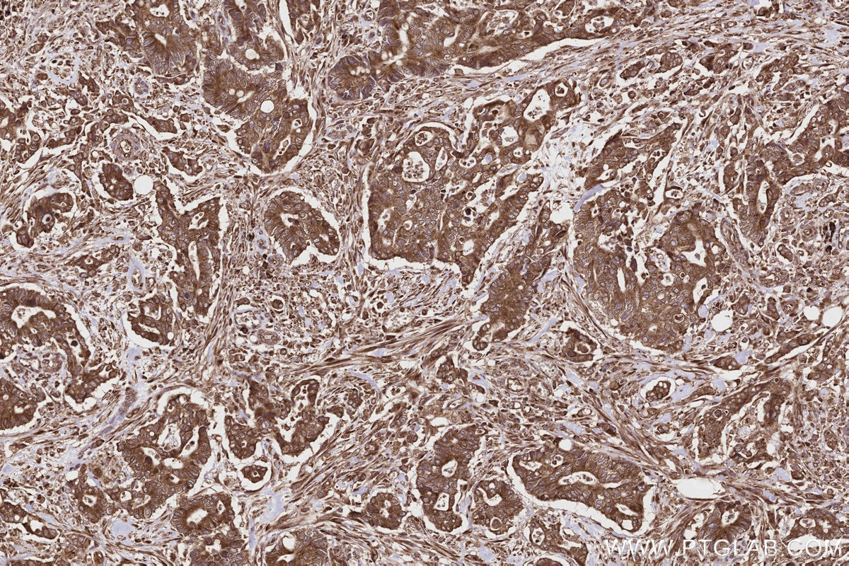 Immunohistochemistry (IHC) staining of human rectal cancer tissue using DDRGK1 Polyclonal antibody (21445-1-AP)