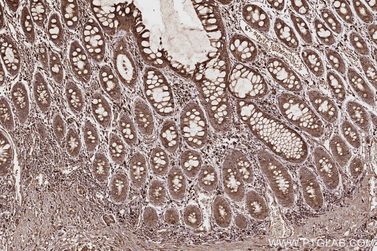 Immunohistochemistry (IHC) staining of human rectal cancer tissue using DDRGK1 Polyclonal antibody (21445-1-AP)