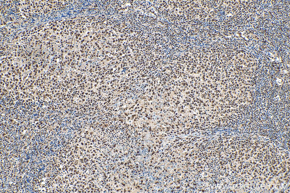 Immunohistochemistry (IHC) staining of human lymphoma tissue using DDX1 Polyclonal antibody (11357-1-AP)