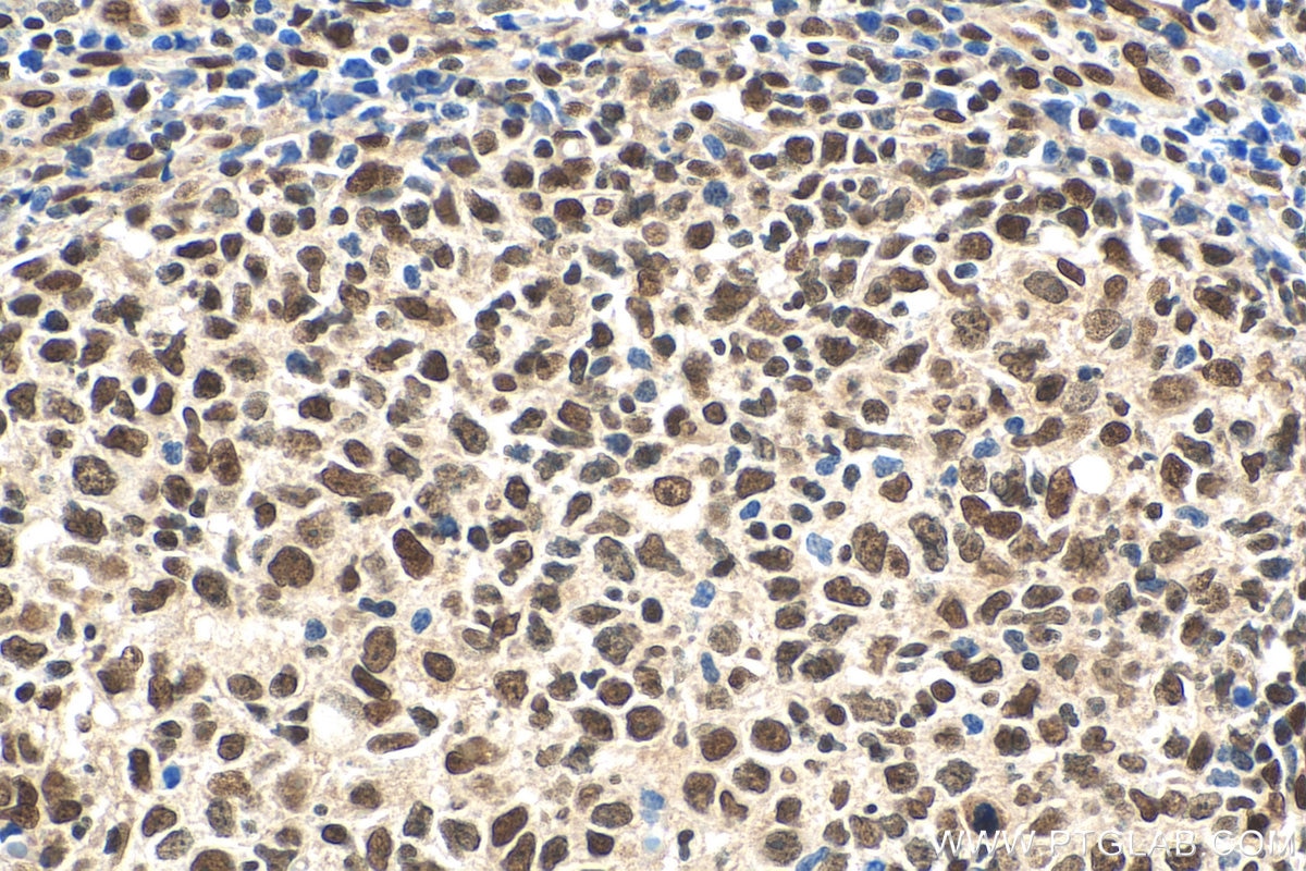 Immunohistochemistry (IHC) staining of human lymphoma tissue using DDX1 Polyclonal antibody (11357-1-AP)