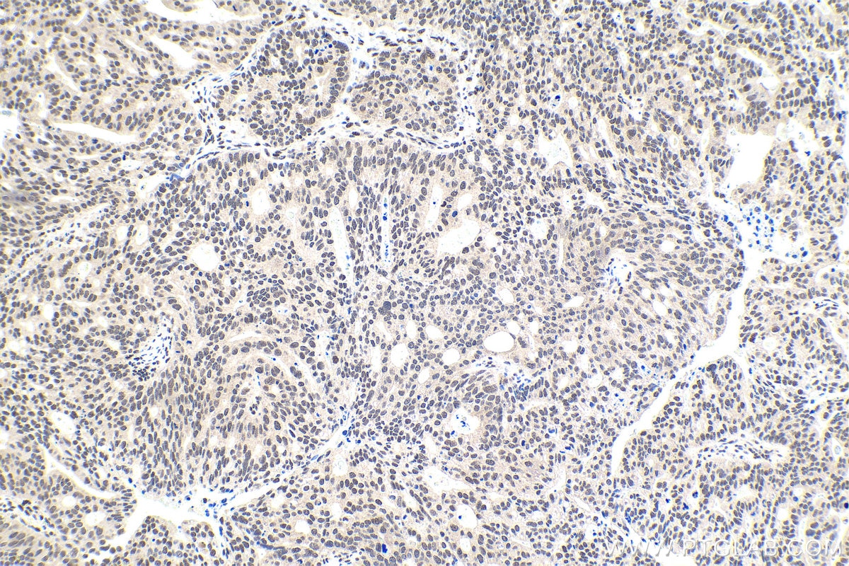 Immunohistochemistry (IHC) staining of human ovary tumor tissue using DDX1 Polyclonal antibody (11357-1-AP)