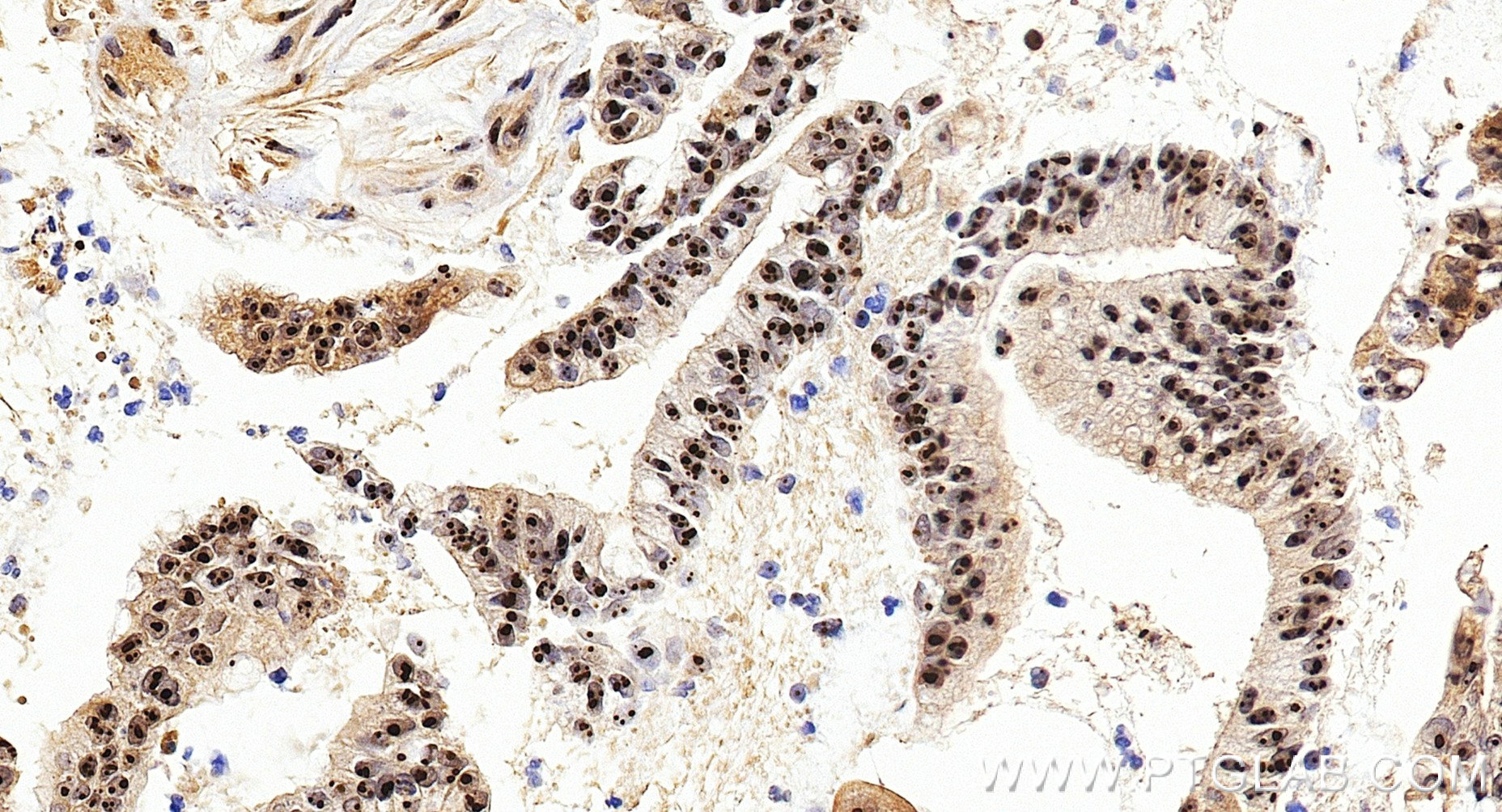 Immunohistochemistry (IHC) staining of human colon cancer tissue using DDX18 Recombinant monoclonal antibody (85789-3-RR)