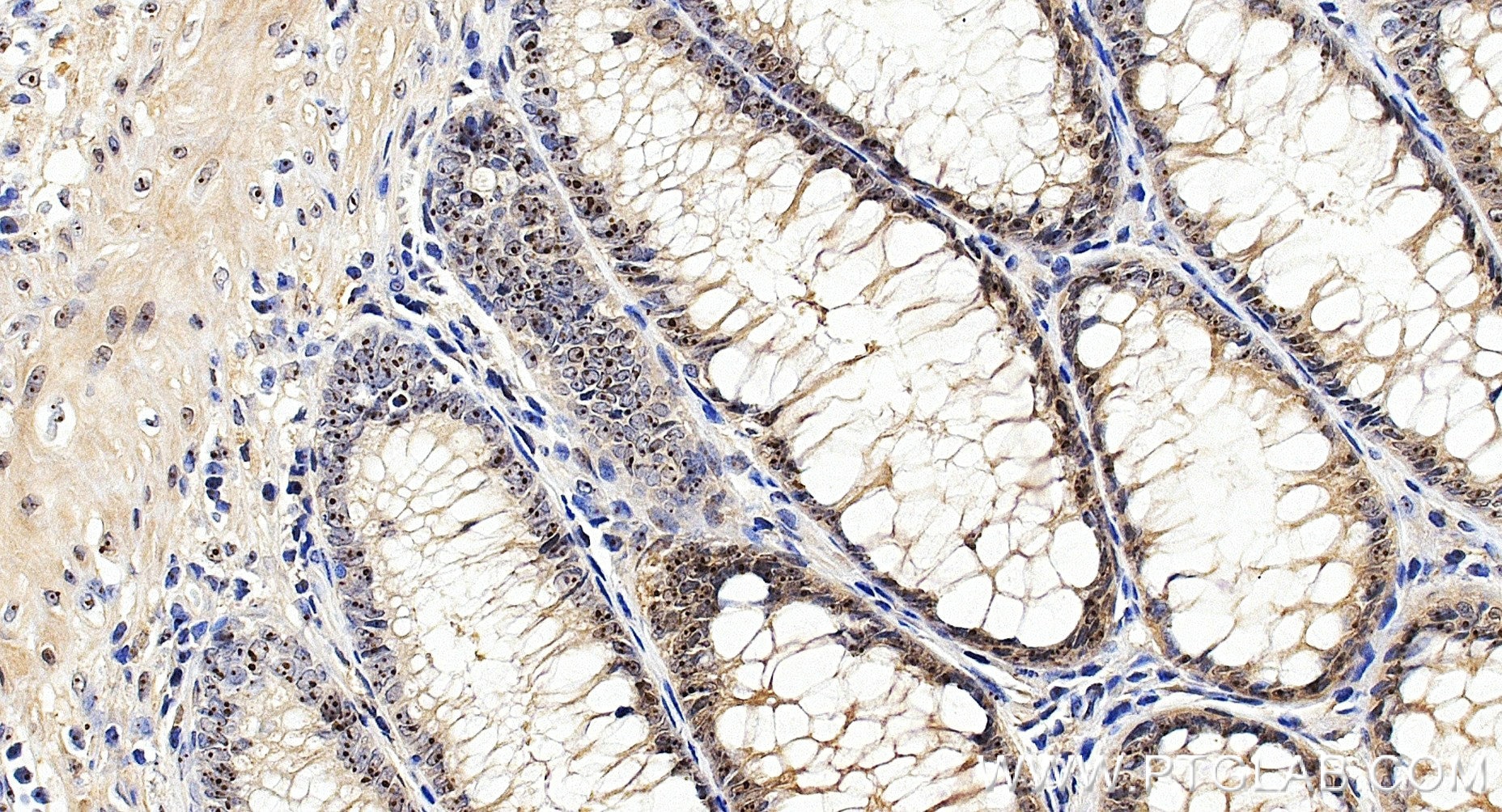Immunohistochemistry (IHC) staining of human colon cancer tissue using DDX18 Recombinant monoclonal antibody (85789-3-RR)