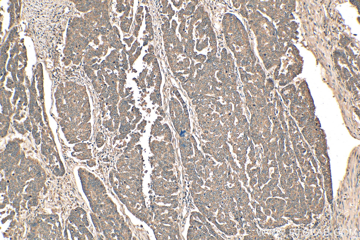 Immunohistochemistry (IHC) staining of human ovary tumor tissue using DDX19A Polyclonal antibody (15209-1-AP)