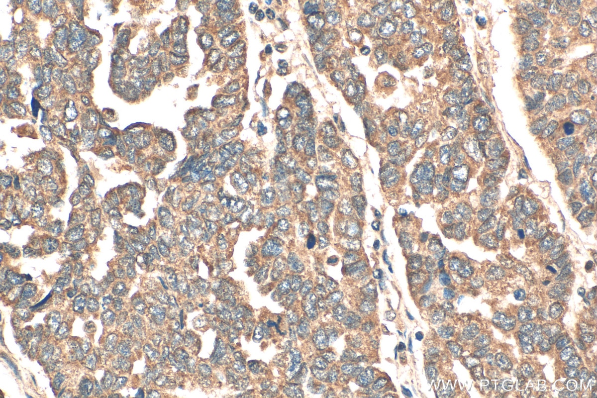 Immunohistochemistry (IHC) staining of human ovary tumor tissue using DDX19A Polyclonal antibody (15209-1-AP)