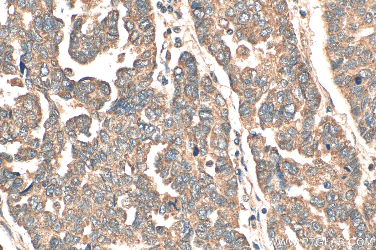 IHC staining of human ovary tumor using 15209-1-AP