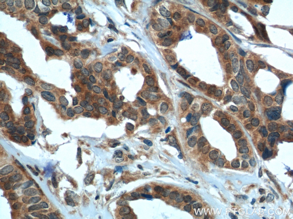 Immunohistochemistry (IHC) staining of human breast cancer tissue using DDX20 Polyclonal antibody (11324-1-AP)